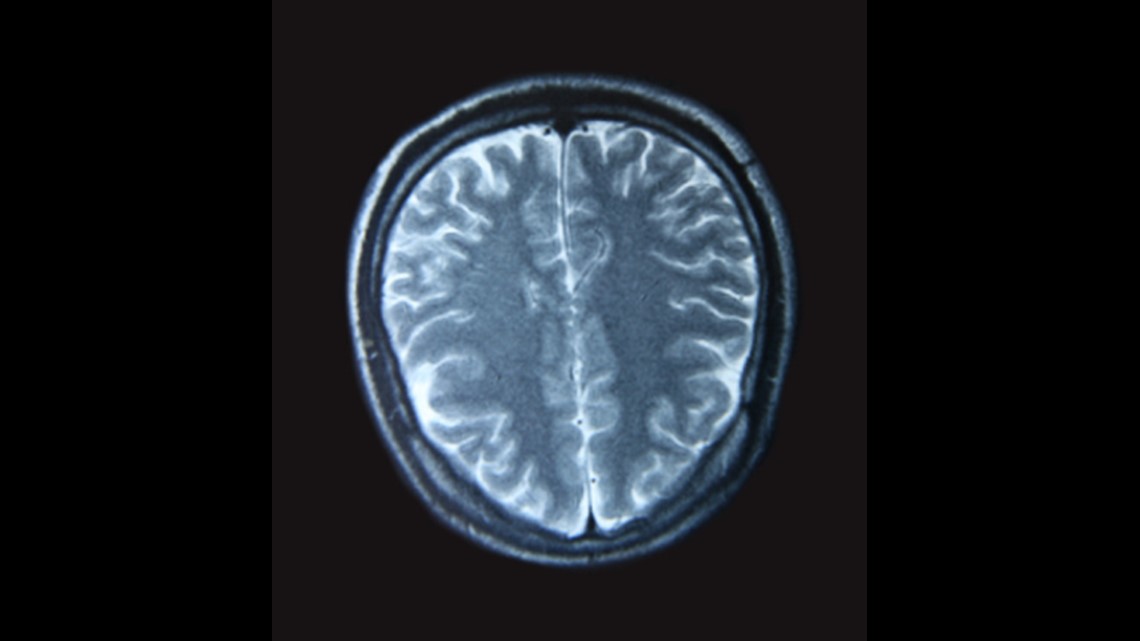NYS advocates for more screening for traumatic brain injuries - Vimarsana News