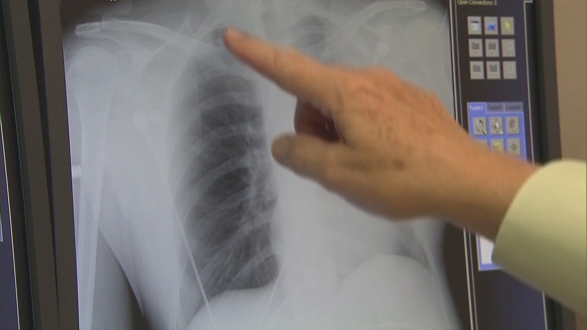 New York makes lung cancer screenings more affordable