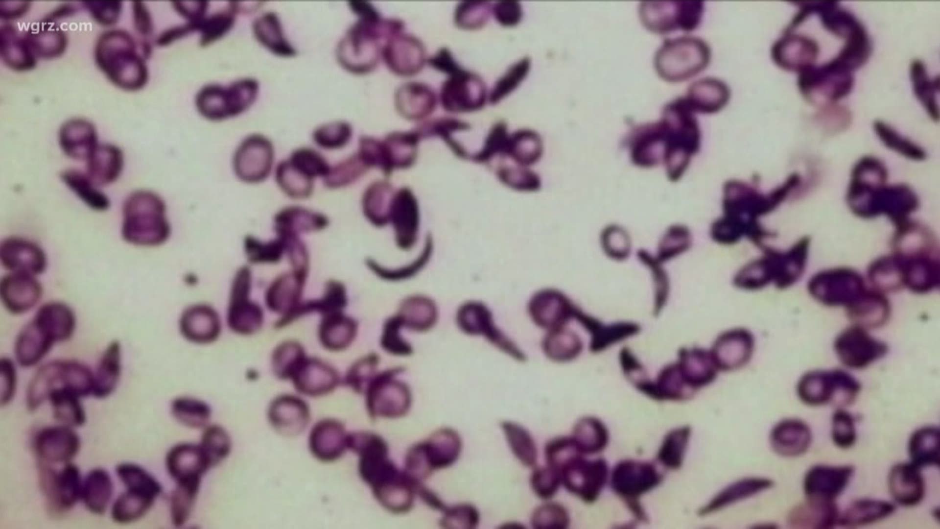New drug could make difference for sickle cell