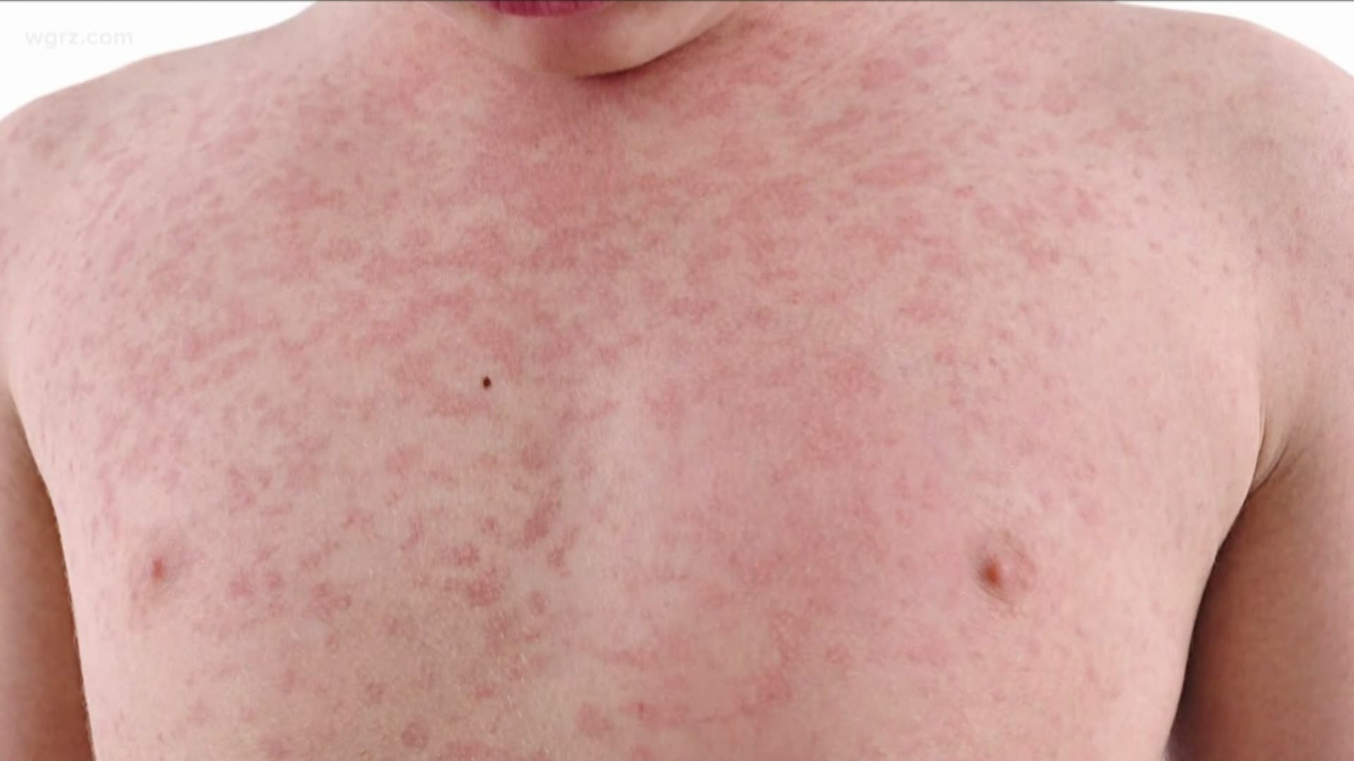 There have been more than 900 cases of measles in the state this year...