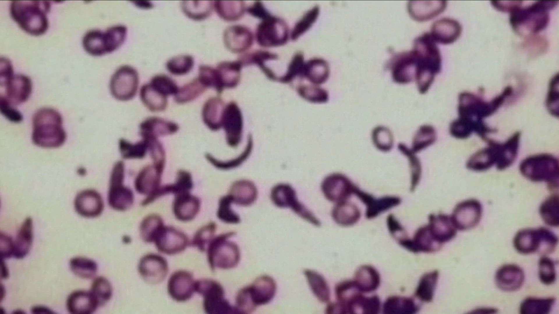 THE CDC THE DISEASE AFFECTS ABOUT 100,000 PEOPLE IN THE UNITED STATES AND MORE THAN 90 PERCENT ARE AFRICAN AMERICAN AND AN ESTIMATED 3 TO 9 PERCENT ARE HISPANIC.