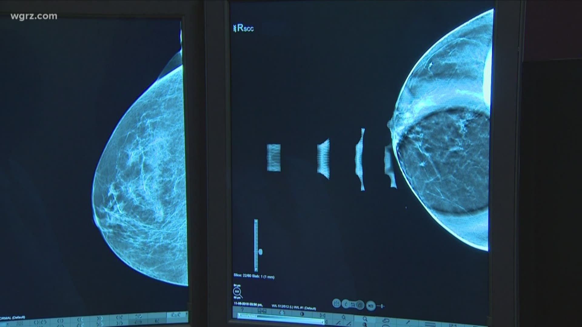 3D mammograms technology to help detect breast cancer