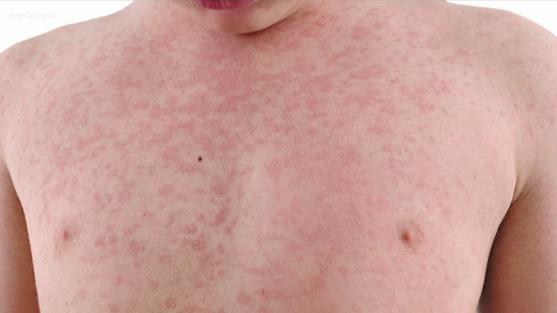 The state health department says it's confirmed five cases of measles in a Mennonite community there.