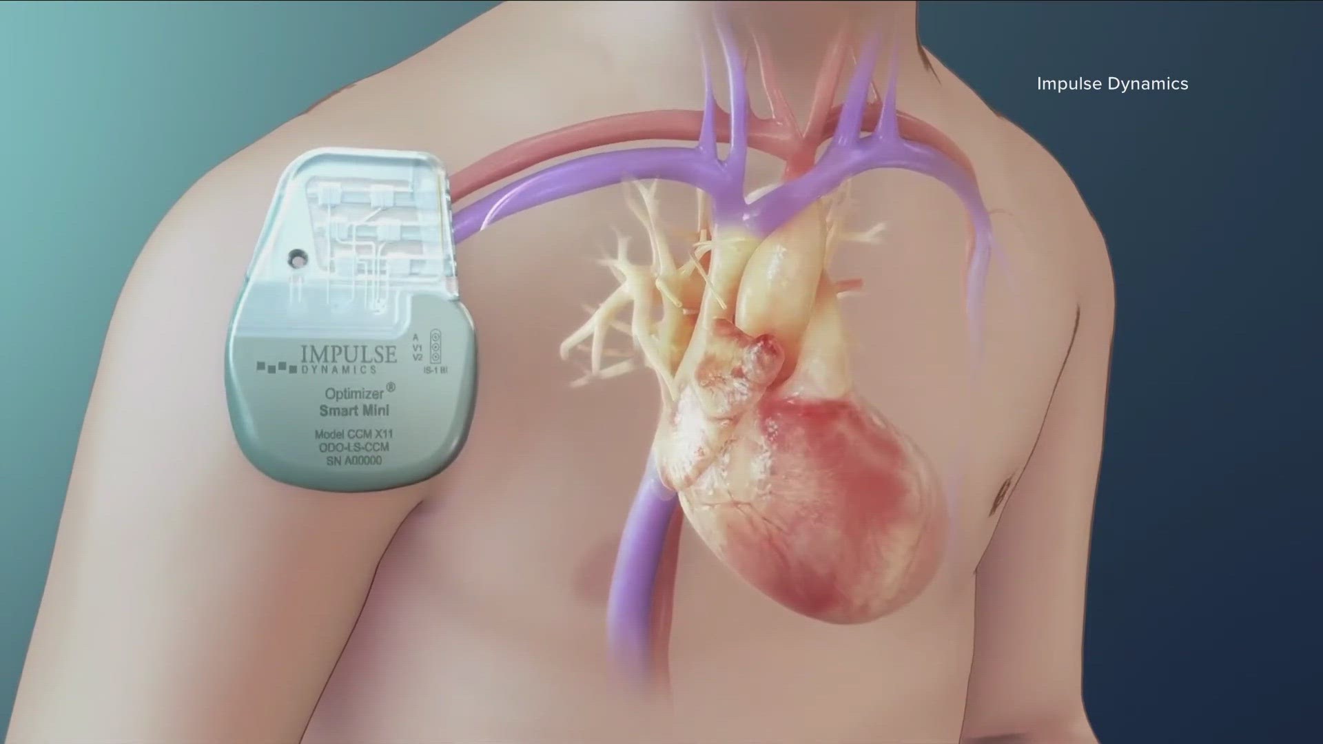 Implanted CCM  device helps patients with congestive heart failure