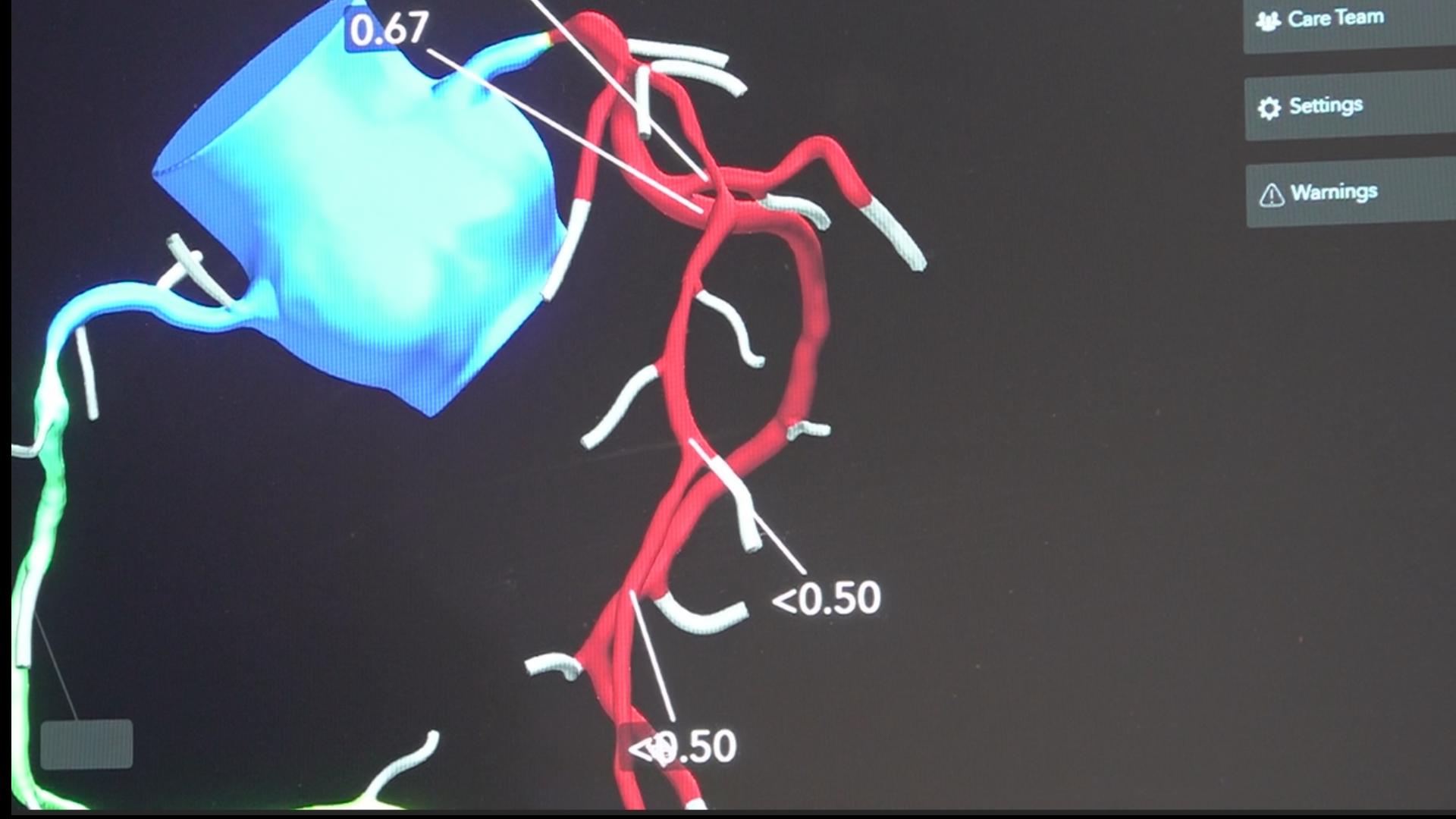 Batavia Hospital using AI program to better diagnose heart disease ...