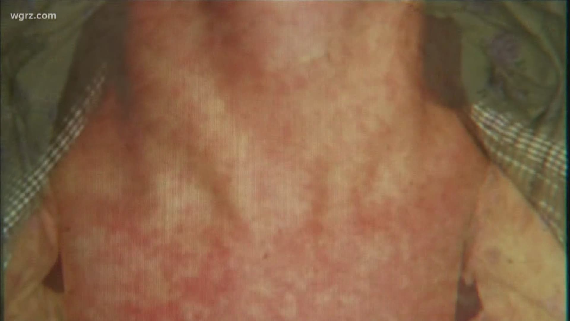 Health Alert Measles  Exposure