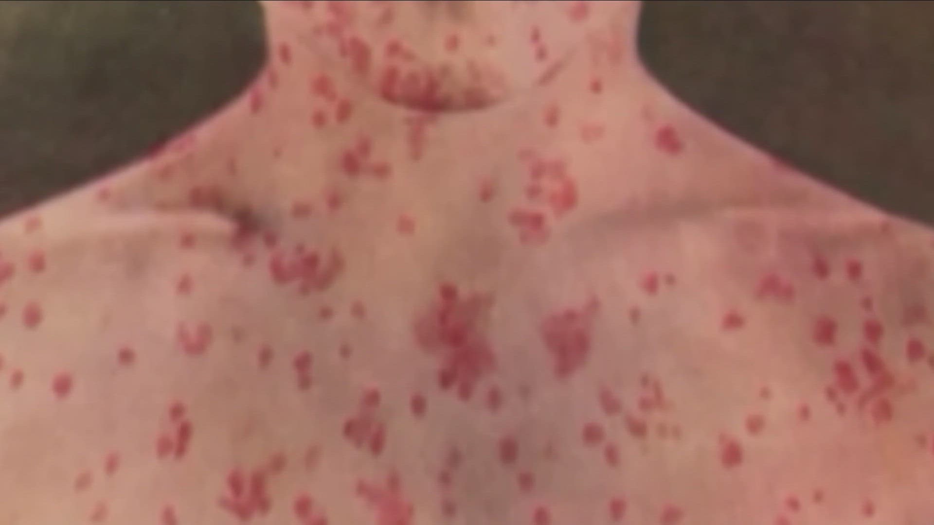 MEASLES OUTBREAK IN THE U-S IS CONCERNING HEALTH EXPERTS.
THE C-D-C REPORTS MORE THAN 100 CASES HAVE BEEN RECORDED SO FAR THIS YEAR.