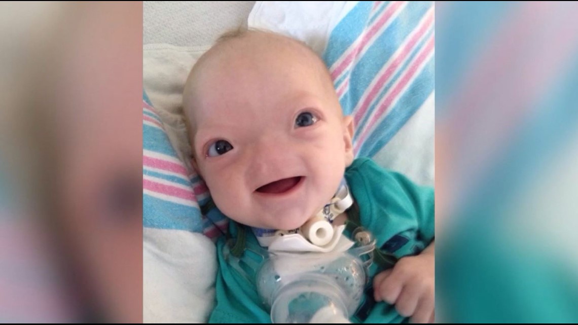Eli Thompson, 'miracle baby' born without nose, dies at 2yearsold